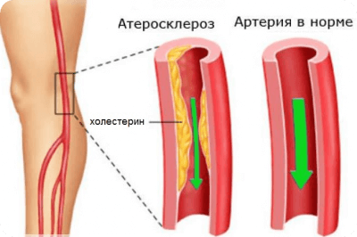 атеросклероз