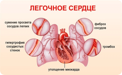 Лечение легочного сердца