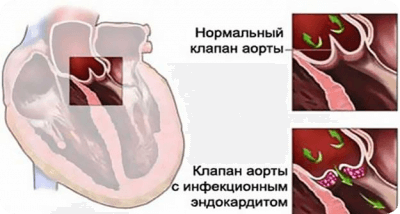 Эндокардит симптомы