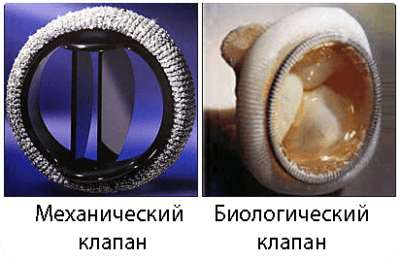 механический и биологический клапан