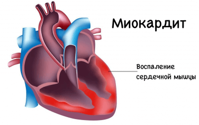 Лечение миокардита