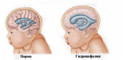 Лечение гидроцефалии