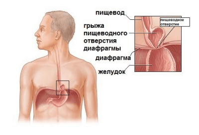 Грыжи пищеводного отверстия диафрагмы