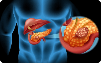 Симптомы рака поджелудочной железы