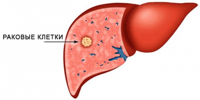 Лечение рака печени