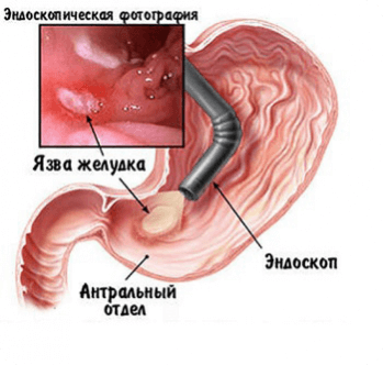 Диагностика язвенной болезни желудка