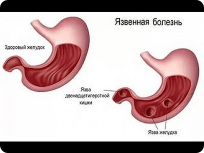 Лечение язвенной болезни желудка