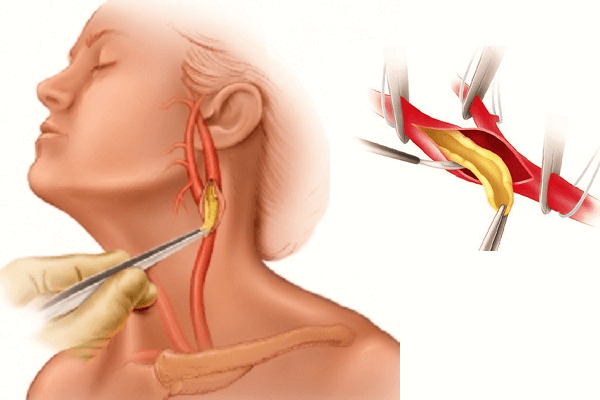 Комбинированные операции на шейных артериях