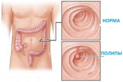 Диагностика полипов кишечника