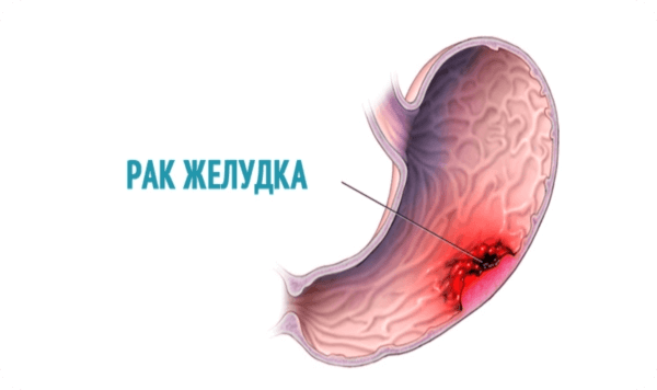 Стадии рака желудка