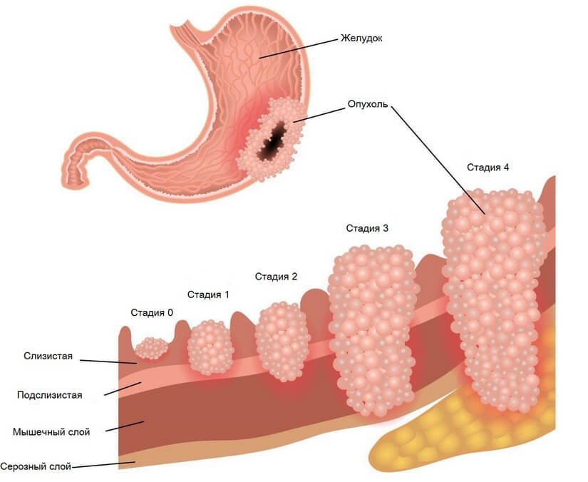 Стдии рака желудка