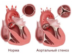 аортальный стеноз