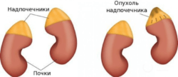 рак надпочечника нв фото / Лечение онкологии в Изриле - клиника Ихилов, цены отзывы форум с врачами