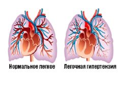 легочная гипертензия