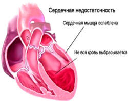 сердечная недостаточность