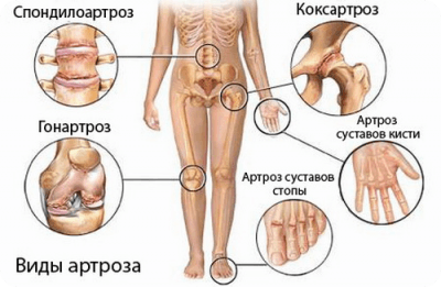 Диагностика артроза