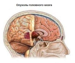 рак мозжечка / рак головного мозга - лечение в Израиле