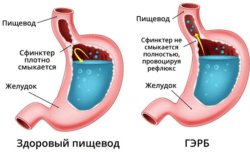 рефлюксня болезнь