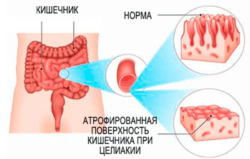 целиакия лечение