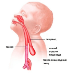  атрезия пищевода 